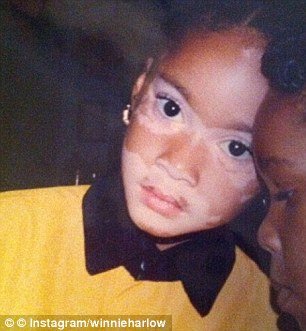 Η 19χρονη καλλονή με τη λεύκη που νίκησε τον ρατσισμό και μεσουρανεί σε διεθνείς πασαρέλες [εικόνες] | iefimerida.gr 8