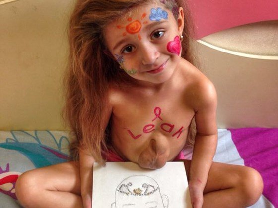 Συγκλονίζει η 5χρονη που ζει με την καρδιά έξω από το σώμα της [εικόνες] | iefimerida.gr 1