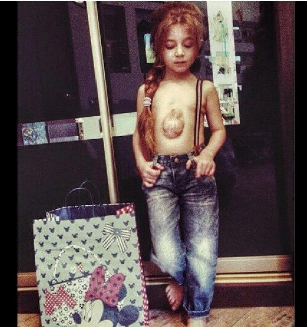 Συγκλονίζει η 5χρονη που ζει με την καρδιά έξω από το σώμα της [εικόνες] | iefimerida.gr 4