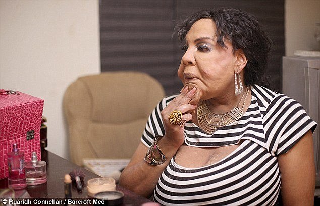 Φρίκη: Εβαλαν σε τρανσέξουαλ, με ενέσεις, τσιμέντο στο πρόσωπο [εικόνες] | iefimerida.gr 4