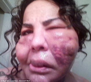 Φρίκη: Εβαλαν σε τρανσέξουαλ, με ενέσεις, τσιμέντο στο πρόσωπο [εικόνες] | iefimerida.gr 2