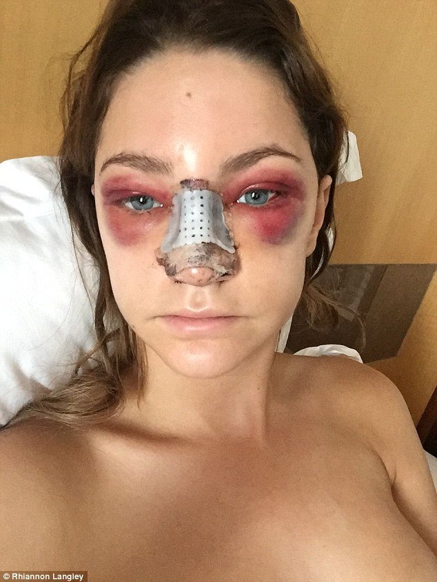 Ετσι γίνεται το πρόσωπο μετά από πλαστική στη μύτη -Η 24χρονη θεά που τόλμησε να το δείξει [εικόνες] | iefimerida.gr 3