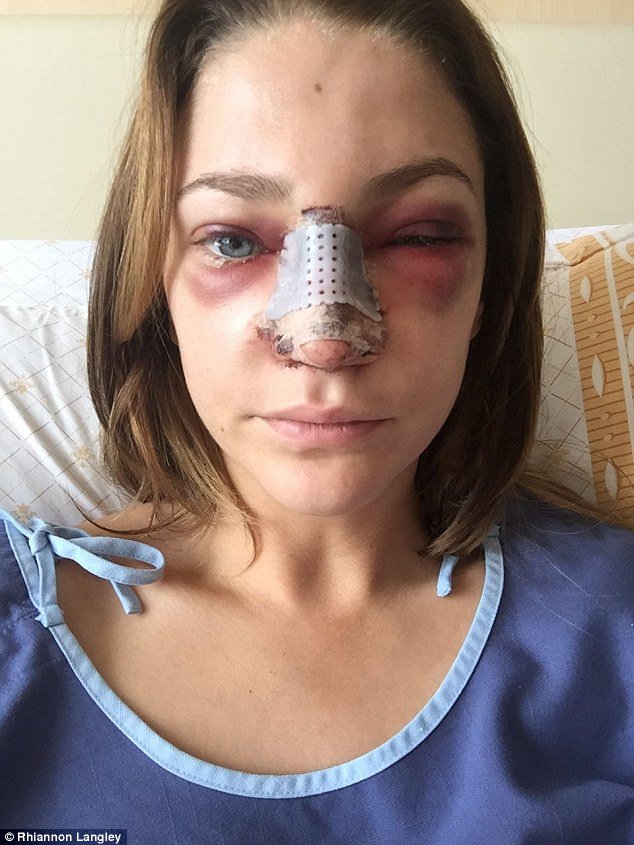 Ετσι γίνεται το πρόσωπο μετά από πλαστική στη μύτη -Η 24χρονη θεά που τόλμησε να το δείξει [εικόνες] | iefimerida.gr 4