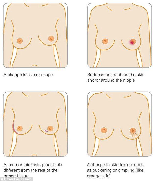 Το λακκάκι στο στήθος που έγινε viral -Γυναίκα με καρκίνο του μαστού δείχνει τα προειδοποιητικά σημάδια [εικόνες]           | iefimerida.gr 3