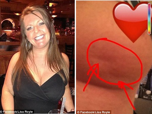 Το λακκάκι στο στήθος που έγινε viral -Γυναίκα με καρκίνο του μαστού δείχνει τα προειδοποιητικά σημάδια [εικόνες]           | iefimerida.gr 1