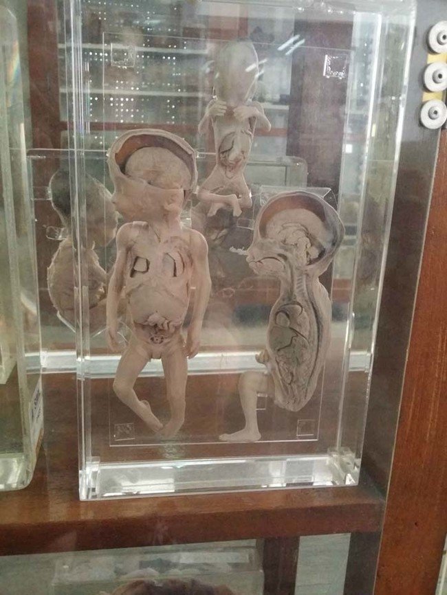 Σκελετοί, εγκέφαλοι και μωρά σε φορμόλη - Το μουσείο του θανάτου βρίσκεται στη Μπανγκόκ [εικόνες]  | iefimerida.gr 3