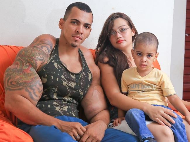 Εκανε ενέσεις λαδιού για να «φουσκώσει» και πήγε να πεθάνει [εικόνες] | iefimerida.gr 5