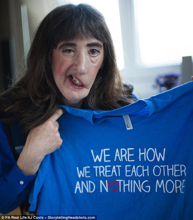 Γυναίκα με μισό σαγόνι δηλώνει περήφανη για την εμφάνιση της και μιλάει για τη ζωή της [εικόνες] | iefimerida.gr 0