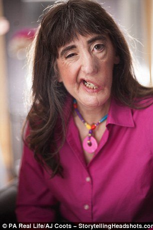 Γυναίκα με μισό σαγόνι δηλώνει περήφανη για την εμφάνιση της και μιλάει για τη ζωή της [εικόνες] | iefimerida.gr 1