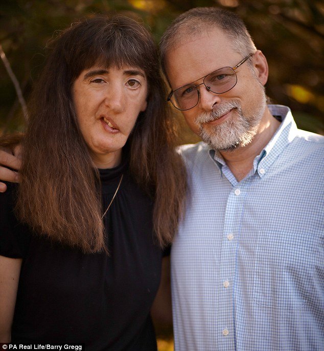 Γυναίκα με μισό σαγόνι δηλώνει περήφανη για την εμφάνιση της και μιλάει για τη ζωή της [εικόνες] | iefimerida.gr 2