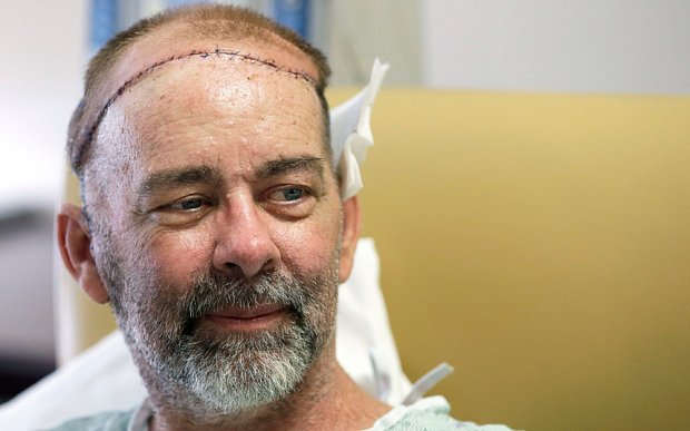 Για πρώτη φορά στα ιατρικά χρονικά: Εγινε μεταμόσχευση κρανίου [εικόνες] | iefimerida.gr 0