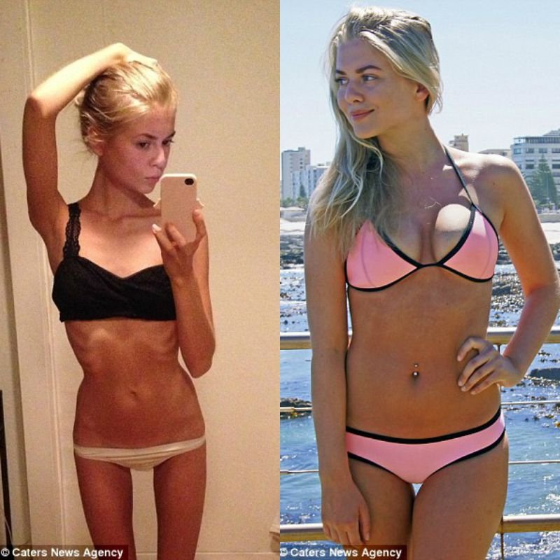 «Δεν ήθελα να είμαι το ανορεξικό κορίτσι» - Τα κατάφερε και δίνει συμβουλές [εικόνες] | iefimerida.gr 1