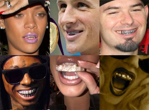 Σιδεράκια στα δόντια –Eγιναν τάση, μόδα, ένδειξη υγείας και πλούτου [εικόνες] | iefimerida.gr 8