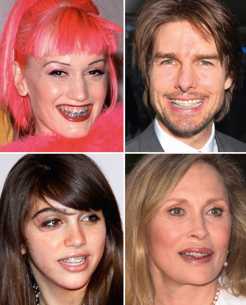 Σιδεράκια στα δόντια –Eγιναν τάση, μόδα, ένδειξη υγείας και πλούτου [εικόνες] | iefimerida.gr 1