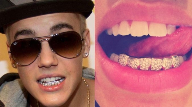 Σιδεράκια στα δόντια –Eγιναν τάση, μόδα, ένδειξη υγείας και πλούτου [εικόνες] | iefimerida.gr 11