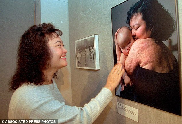 «Το κορίτσι του ναπάλμ»: Απαλλάσσεται από τα σημάδια της ατομικής βόμβας 43 χρόνια μετά [εικόνες]  | iefimerida.gr 5