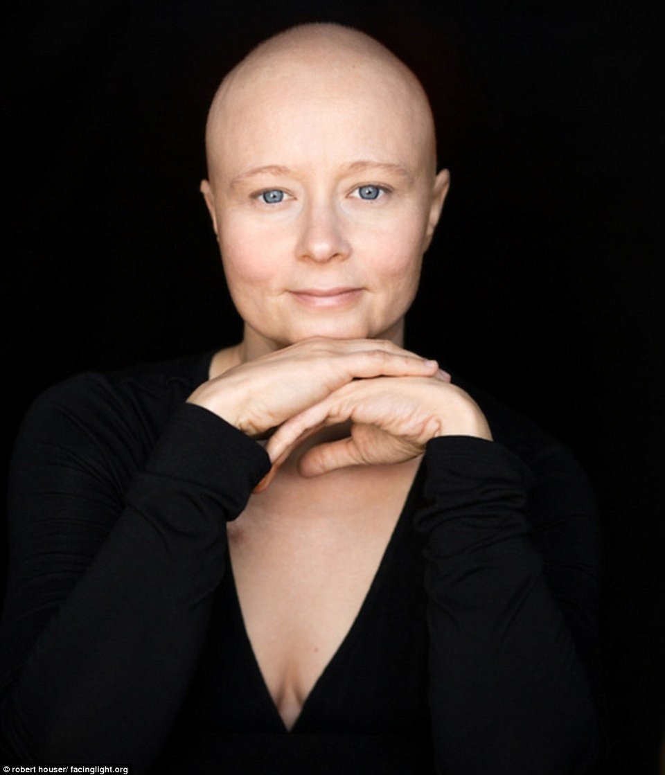 Tο πρόσωπο της χημειοθεραπείας -Καρκινοπαθείς φωτογραφίζονται και δείχνουν τα σημάδια της και τις ουλές τους [εικόνες] | iefimerida.gr 0