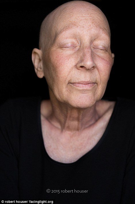 Tο πρόσωπο της χημειοθεραπείας -Καρκινοπαθείς φωτογραφίζονται και δείχνουν τα σημάδια της και τις ουλές τους [εικόνες] | iefimerida.gr 11