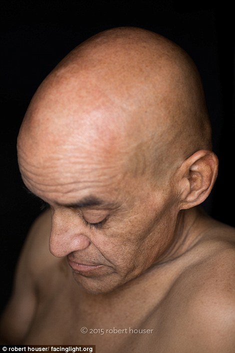 Tο πρόσωπο της χημειοθεραπείας -Καρκινοπαθείς φωτογραφίζονται και δείχνουν τα σημάδια της και τις ουλές τους [εικόνες] | iefimerida.gr 12