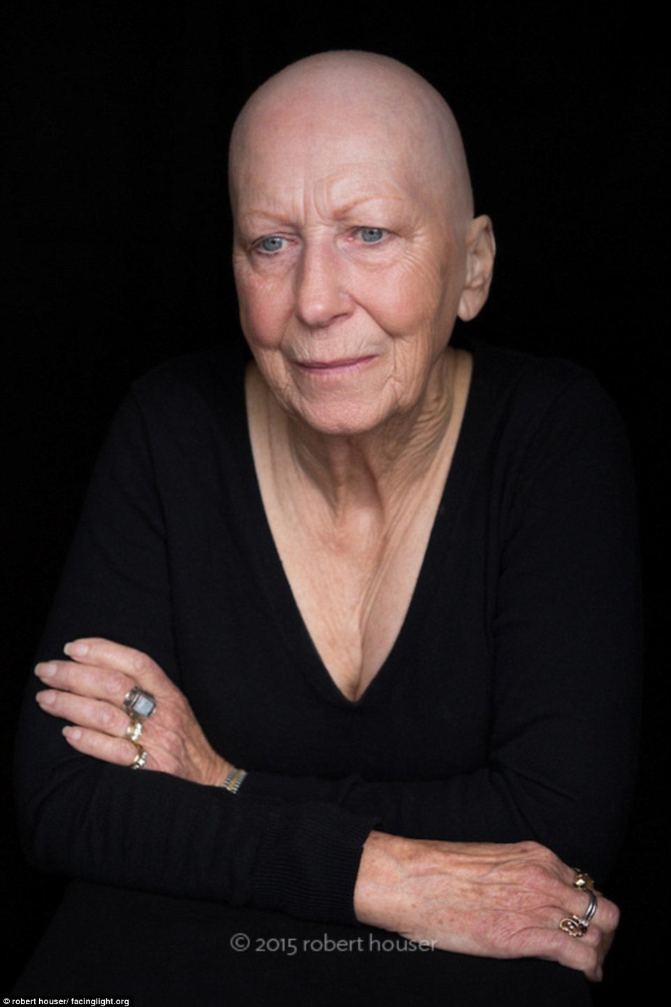 Tο πρόσωπο της χημειοθεραπείας -Καρκινοπαθείς φωτογραφίζονται και δείχνουν τα σημάδια της και τις ουλές τους [εικόνες] | iefimerida.gr 13