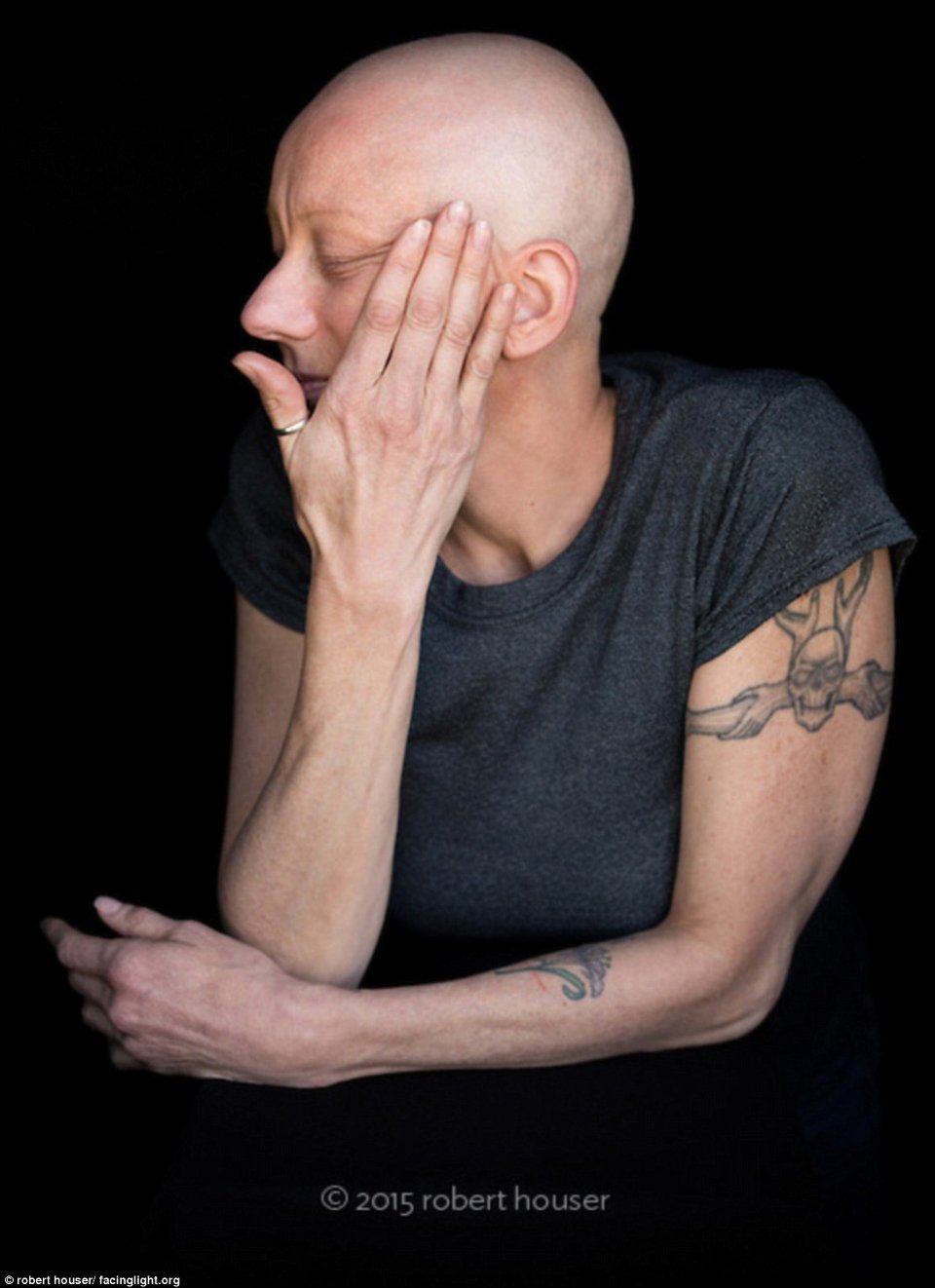 Tο πρόσωπο της χημειοθεραπείας -Καρκινοπαθείς φωτογραφίζονται και δείχνουν τα σημάδια της και τις ουλές τους [εικόνες] | iefimerida.gr 14