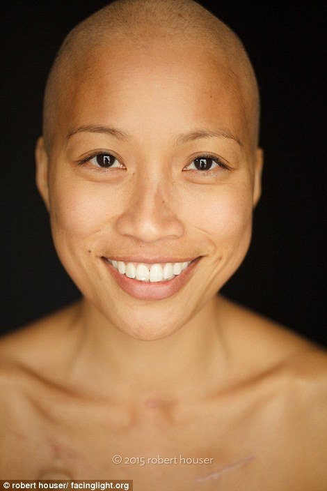 Tο πρόσωπο της χημειοθεραπείας -Καρκινοπαθείς φωτογραφίζονται και δείχνουν τα σημάδια της και τις ουλές τους [εικόνες] | iefimerida.gr 15