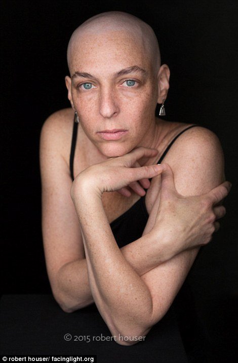 Tο πρόσωπο της χημειοθεραπείας -Καρκινοπαθείς φωτογραφίζονται και δείχνουν τα σημάδια της και τις ουλές τους [εικόνες] | iefimerida.gr 16