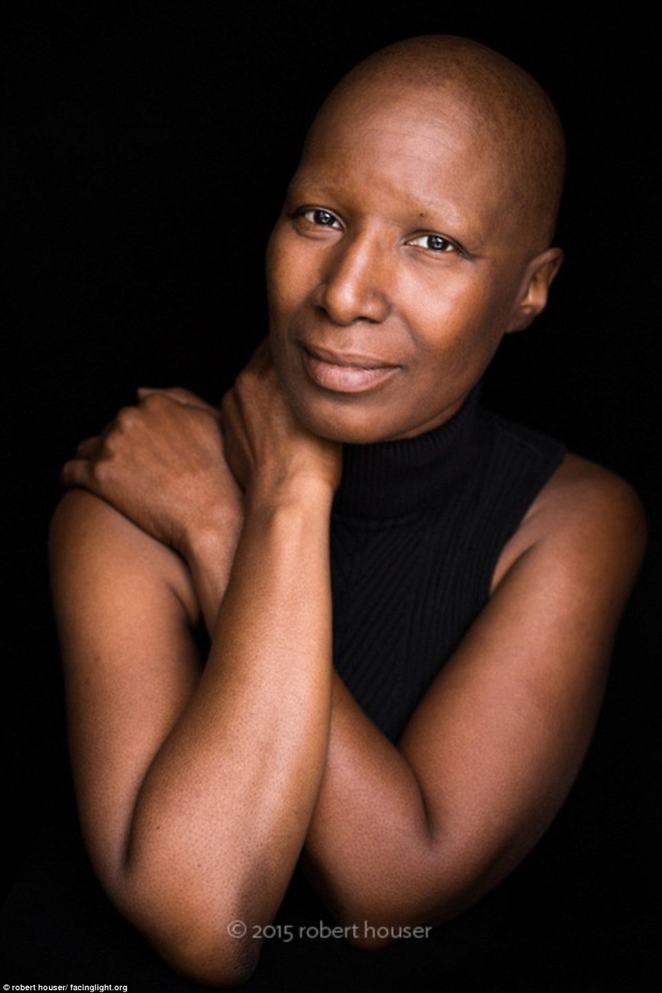 Tο πρόσωπο της χημειοθεραπείας -Καρκινοπαθείς φωτογραφίζονται και δείχνουν τα σημάδια της και τις ουλές τους [εικόνες] | iefimerida.gr 18