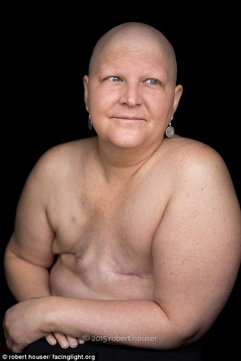 Tο πρόσωπο της χημειοθεραπείας -Καρκινοπαθείς φωτογραφίζονται και δείχνουν τα σημάδια της και τις ουλές τους [εικόνες] | iefimerida.gr 19