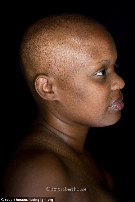 Tο πρόσωπο της χημειοθεραπείας -Καρκινοπαθείς φωτογραφίζονται και δείχνουν τα σημάδια της και τις ουλές τους [εικόνες] | iefimerida.gr 1