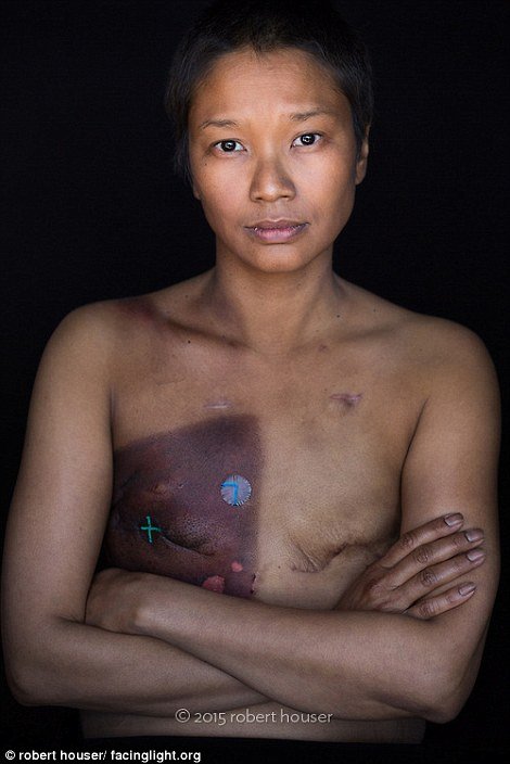 Tο πρόσωπο της χημειοθεραπείας -Καρκινοπαθείς φωτογραφίζονται και δείχνουν τα σημάδια της και τις ουλές τους [εικόνες] | iefimerida.gr 20