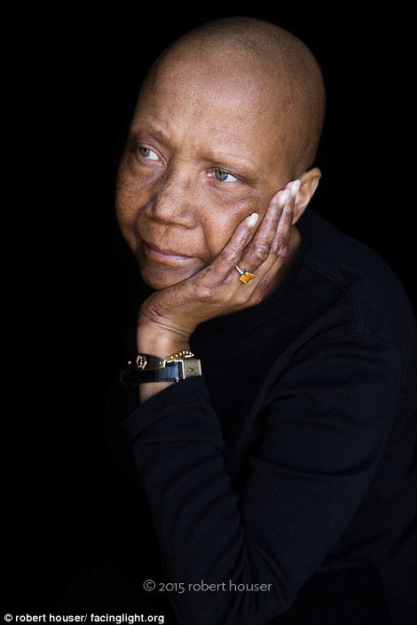 Tο πρόσωπο της χημειοθεραπείας -Καρκινοπαθείς φωτογραφίζονται και δείχνουν τα σημάδια της και τις ουλές τους [εικόνες] | iefimerida.gr 2