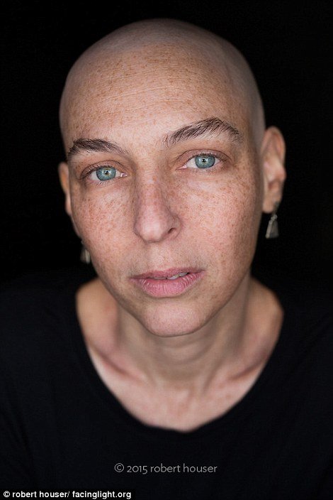 Tο πρόσωπο της χημειοθεραπείας -Καρκινοπαθείς φωτογραφίζονται και δείχνουν τα σημάδια της και τις ουλές τους [εικόνες] | iefimerida.gr 3