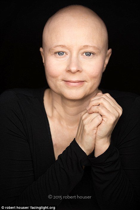 Tο πρόσωπο της χημειοθεραπείας -Καρκινοπαθείς φωτογραφίζονται και δείχνουν τα σημάδια της και τις ουλές τους [εικόνες] | iefimerida.gr 4