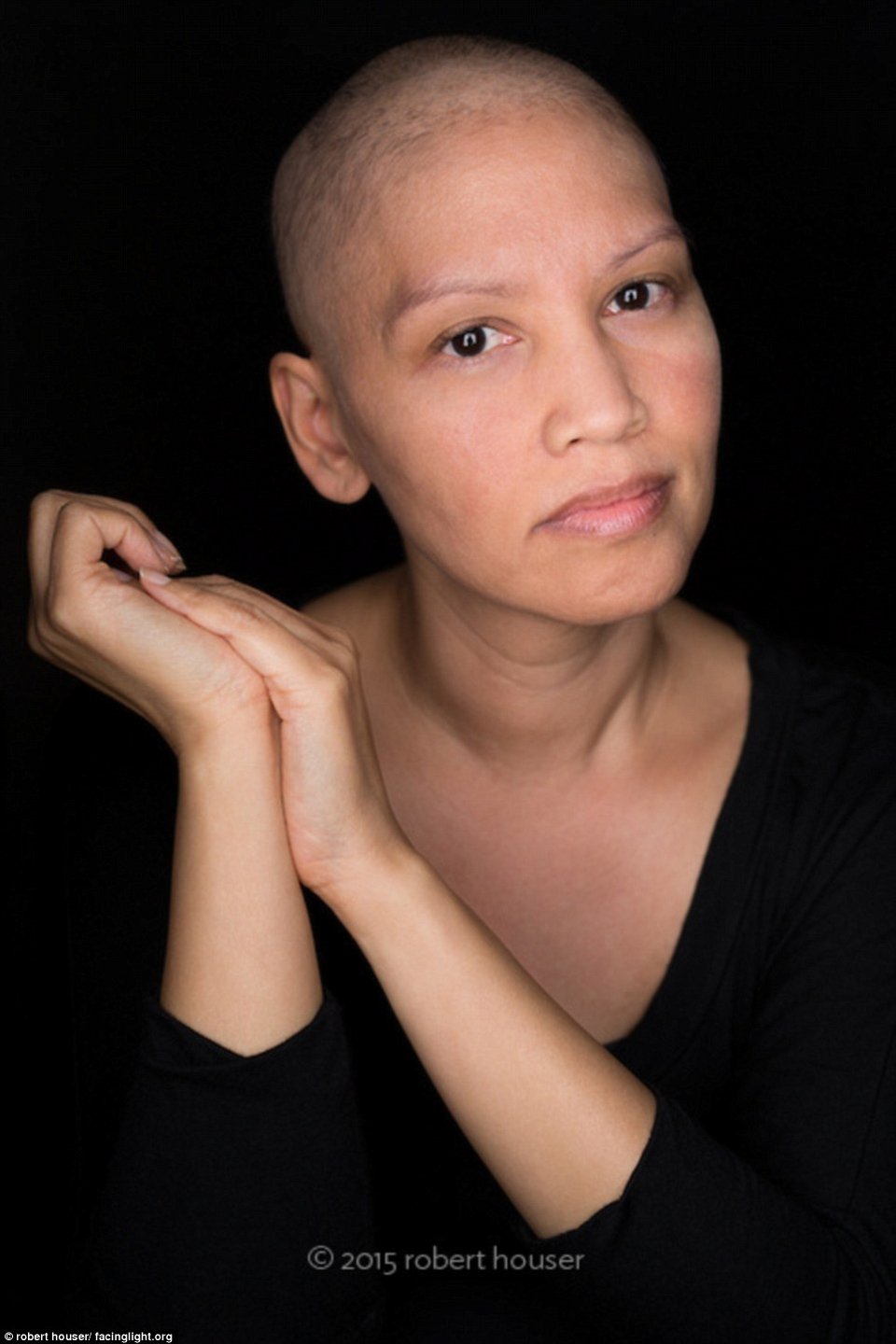 Tο πρόσωπο της χημειοθεραπείας -Καρκινοπαθείς φωτογραφίζονται και δείχνουν τα σημάδια της και τις ουλές τους [εικόνες] | iefimerida.gr 6