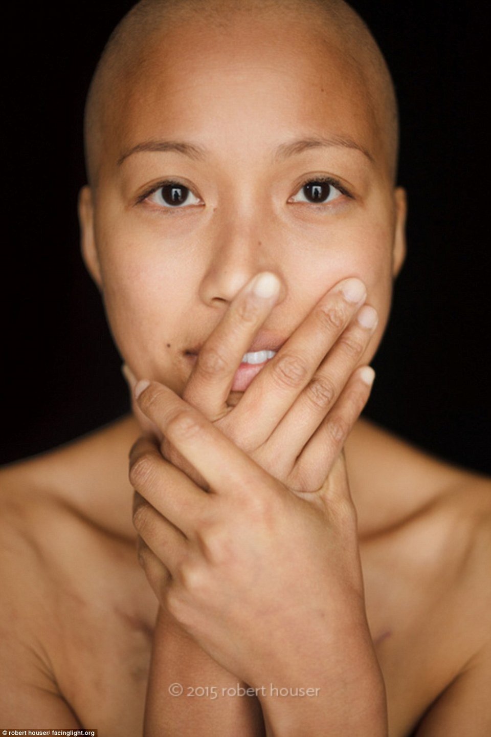 Tο πρόσωπο της χημειοθεραπείας -Καρκινοπαθείς φωτογραφίζονται και δείχνουν τα σημάδια της και τις ουλές τους [εικόνες] | iefimerida.gr 7