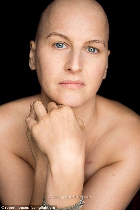 Tο πρόσωπο της χημειοθεραπείας -Καρκινοπαθείς φωτογραφίζονται και δείχνουν τα σημάδια της και τις ουλές τους [εικόνες] | iefimerida.gr 9