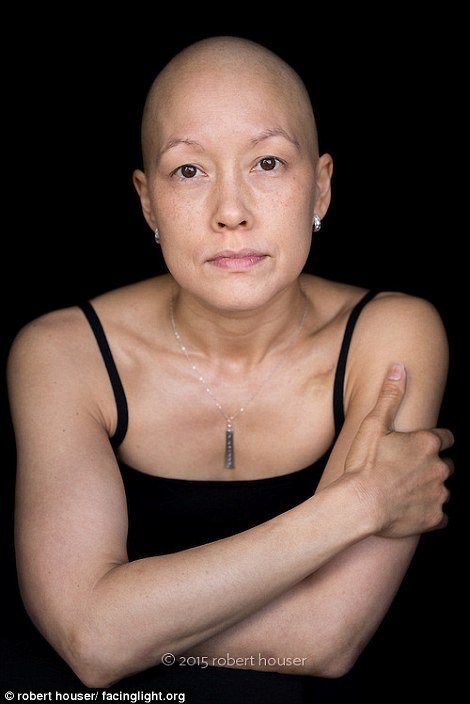 Tο πρόσωπο της χημειοθεραπείας -Καρκινοπαθείς φωτογραφίζονται και δείχνουν τα σημάδια της και τις ουλές τους [εικόνες] | iefimerida.gr 8