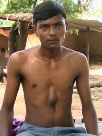 Ενα θαύμα της ιατρικής: 18χρονος άντρας που ζει με την καρδιά έξω από το στήθος [εικόνες]  | iefimerida.gr 2