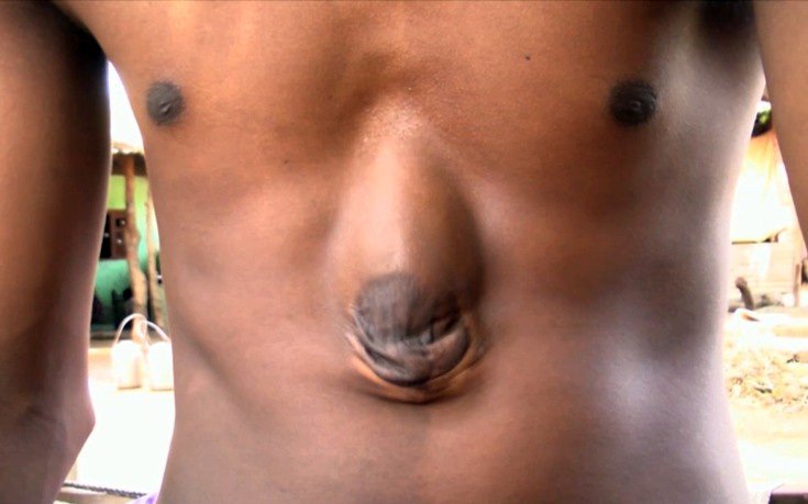 Ενα θαύμα της ιατρικής: 18χρονος άντρας που ζει με την καρδιά έξω από το στήθος [εικόνες]  | iefimerida.gr 3