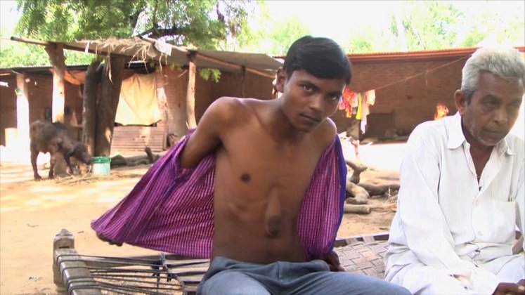 Ενα θαύμα της ιατρικής: 18χρονος άντρας που ζει με την καρδιά έξω από το στήθος [εικόνες]  | iefimerida.gr 1