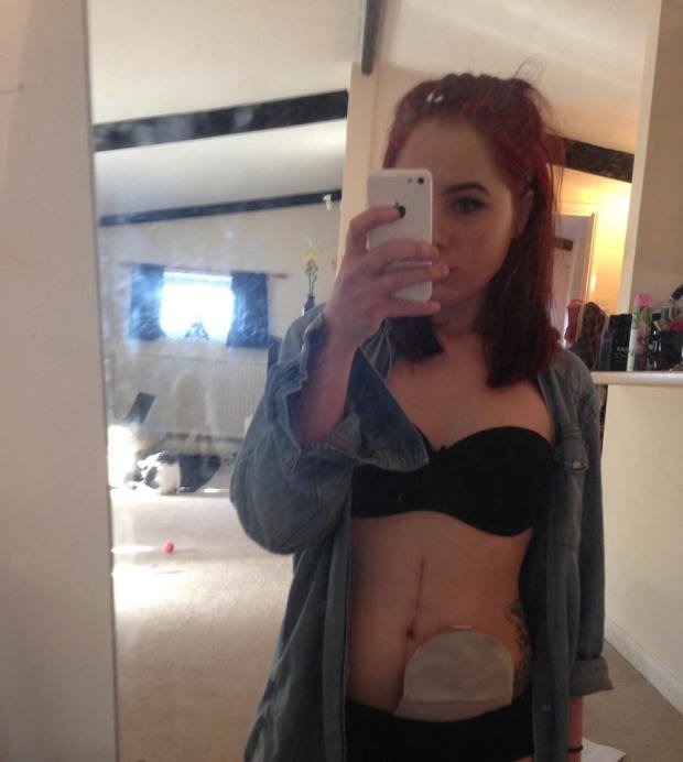  19χρονη καθηλώνει: Εβγαλε την τσάντα κολοστομίας και γράφει για τη ζωή της με αυτή και χωρίς αυτήν [εικόνες] | iefimerida.gr 0