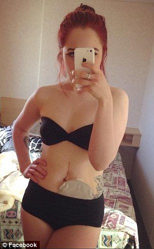  19χρονη καθηλώνει: Εβγαλε την τσάντα κολοστομίας και γράφει για τη ζωή της με αυτή και χωρίς αυτήν [εικόνες] | iefimerida.gr 1