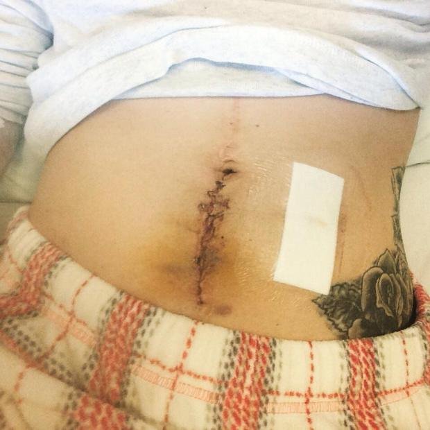  19χρονη καθηλώνει: Εβγαλε την τσάντα κολοστομίας και γράφει για τη ζωή της με αυτή και χωρίς αυτήν [εικόνες] | iefimerida.gr 2