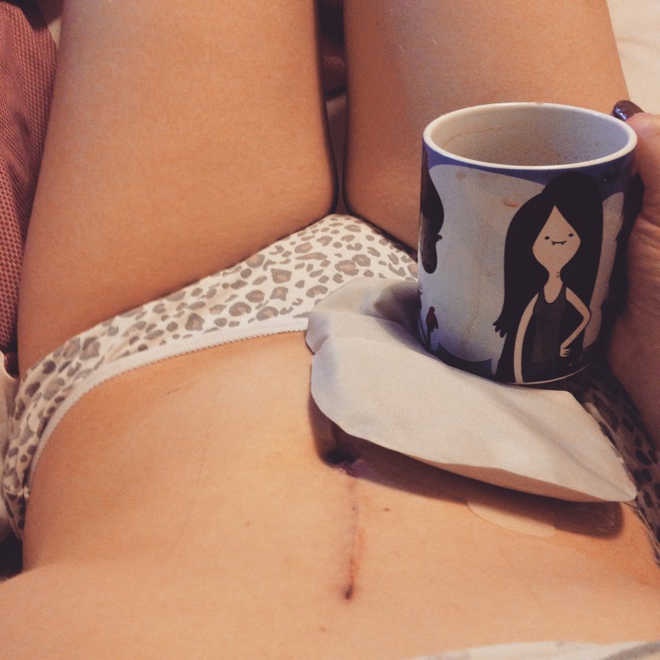  19χρονη καθηλώνει: Εβγαλε την τσάντα κολοστομίας και γράφει για τη ζωή της με αυτή και χωρίς αυτήν [εικόνες] | iefimerida.gr 8