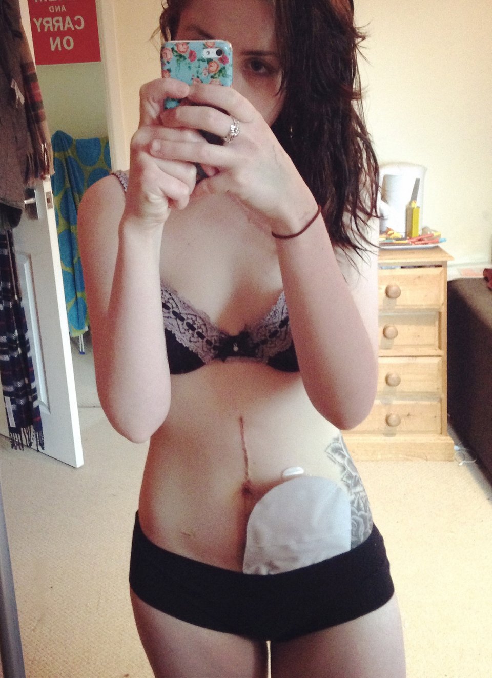  19χρονη καθηλώνει: Εβγαλε την τσάντα κολοστομίας και γράφει για τη ζωή της με αυτή και χωρίς αυτήν [εικόνες] | iefimerida.gr 9