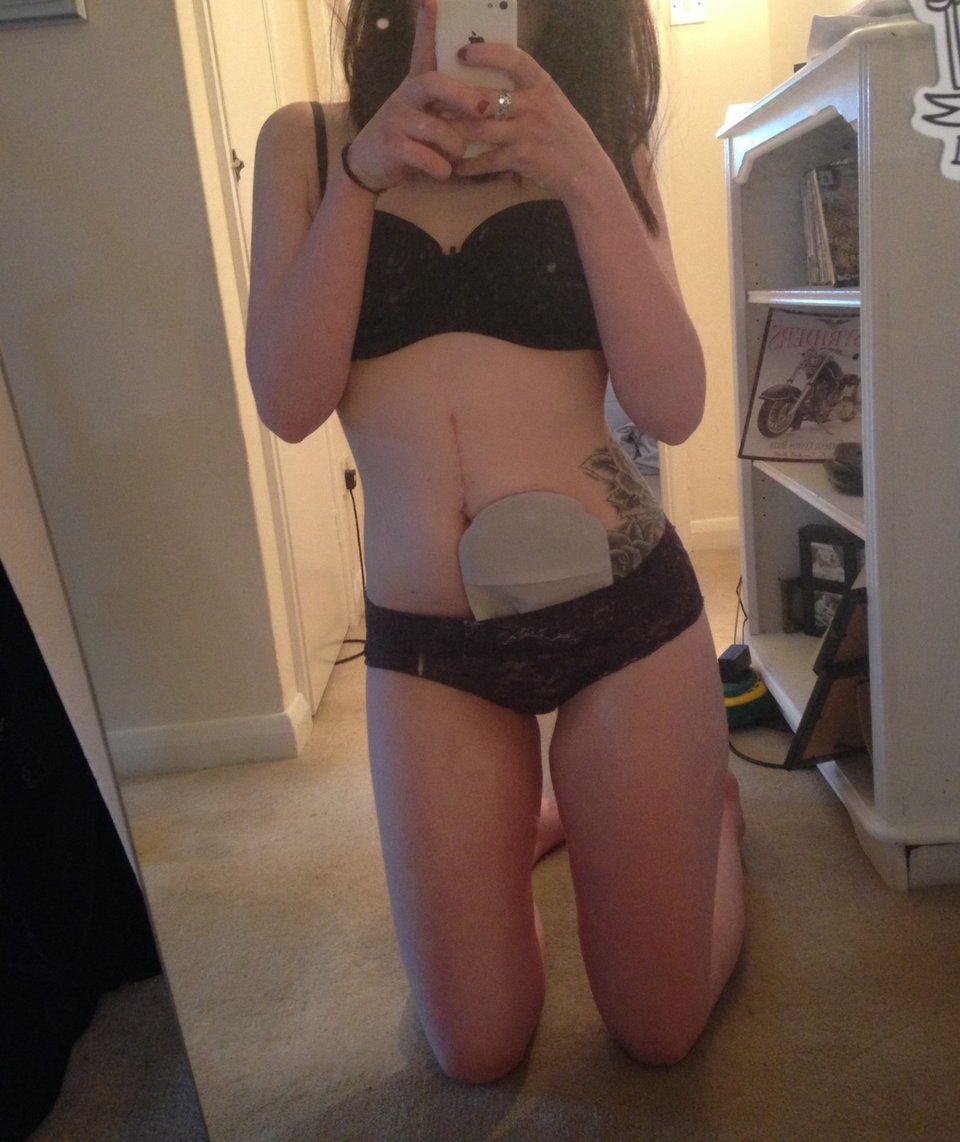  19χρονη καθηλώνει: Εβγαλε την τσάντα κολοστομίας και γράφει για τη ζωή της με αυτή και χωρίς αυτήν [εικόνες] | iefimerida.gr 10