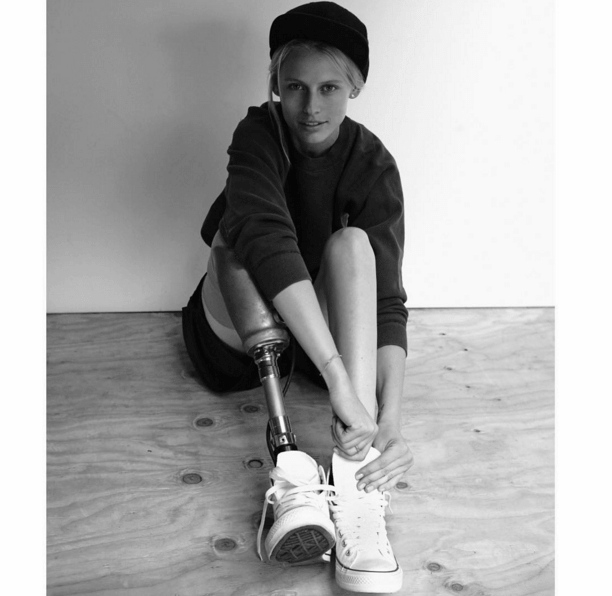 Της έκοψαν το πόδι εξαιτίας ενός ταμπόν -Πώς ζει σήμερα το πανέμορφο μοντέλο [εικόνες] | iefimerida.gr 7