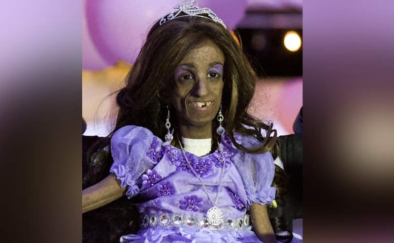 Η 15χρονη Κολομβιανή που μοιάζει με 90 χρονών -Πάσχει από σπάνια ασθένεια [εικόνες] | iefimerida.gr 2