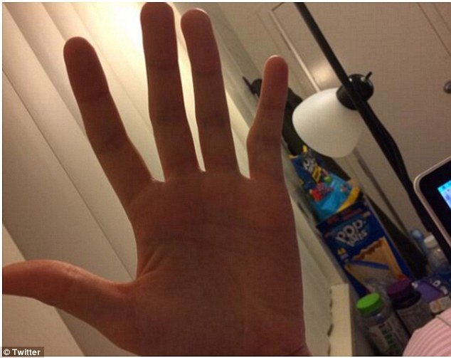 Ποστάρουν φωτογραφίες με τα παραμορφωμένα τους δάχτυλα -Από την ατελείωτη χρήση smart phones [εικόνες] | iefimerida.gr 2